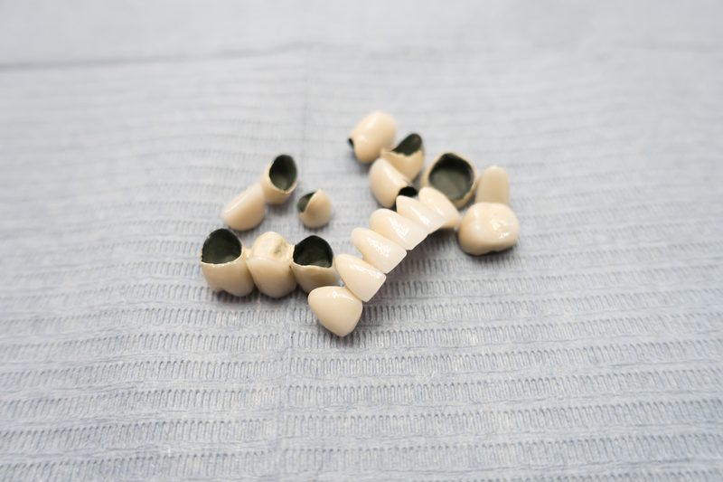 PFM porcelain fused to metal crown — dental laboratory Sydney